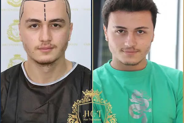 HIV Positive Hair Transplant in Turkey - Resim 5