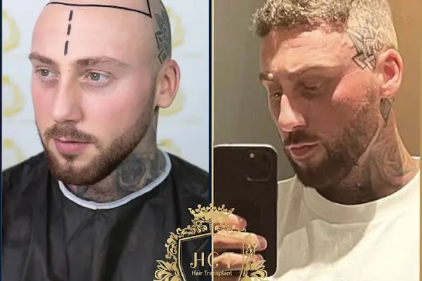 HIV Positive Hair Transplant in Turkey - Resim 4