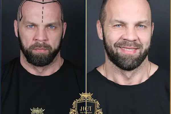 HIV Positive Hair Transplant in Turkey - Resim 19