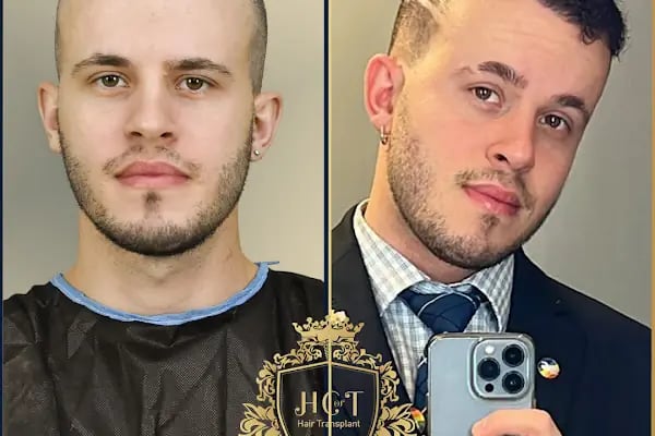 HIV Positive Hair Transplant in Turkey - Resim 6