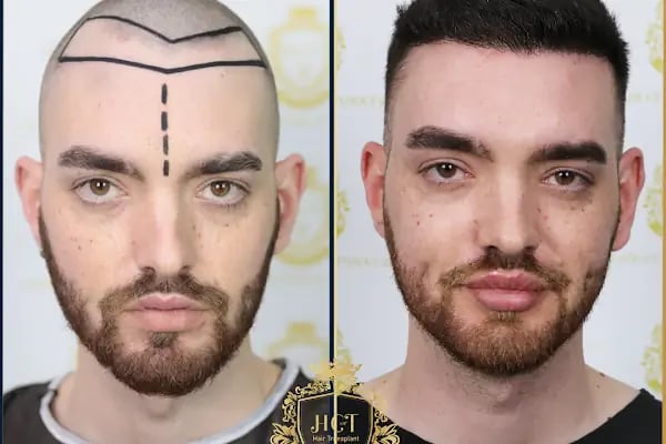HIV Positive Hair Transplant in Turkey - Resim 14