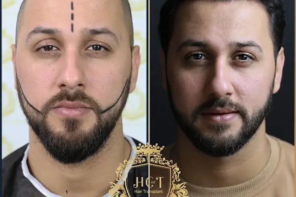 HIV Positive Hair Transplant in Turkey - Resim 1