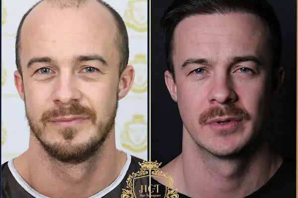 HIV Positive Hair Transplant in Turkey - Resim 18