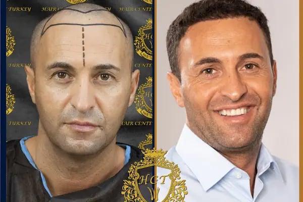 HIV Positive Hair Transplant in Turkey - Resim 16