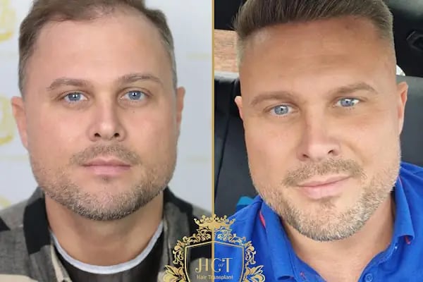 HIV Positive Hair Transplant in Turkey - Resim 3