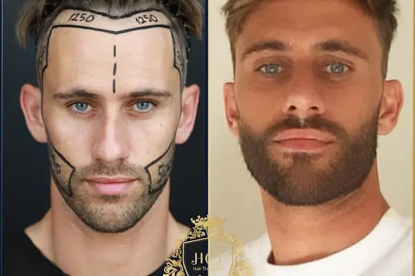 HIV Positive Hair Transplant in Turkey - Resim 13