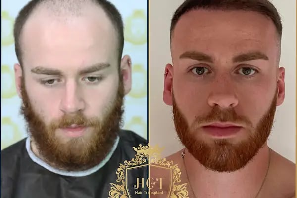 HIV Positive Hair Transplant in Turkey - Resim 9