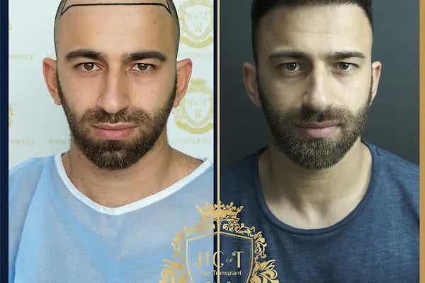 HIV Positive Hair Transplant in Turkey - Resim 8