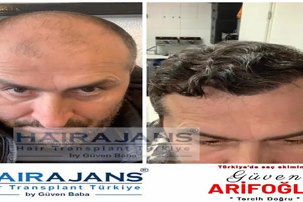 Hair Ajans Saç Ekim Merkezi - Resim 4