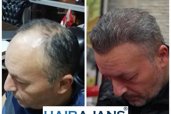 Hair Ajans Saç Ekim Merkezi - Resim 19