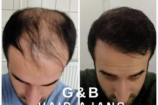 Hair Ajans Saç Ekim Merkezi - Resim 5