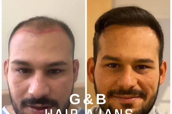 Hair Ajans Saç Ekim Merkezi - Resim 10