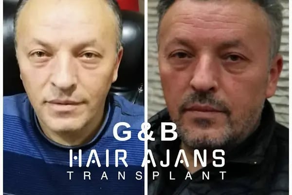 Hair Ajans Saç Ekim Merkezi - Resim 12