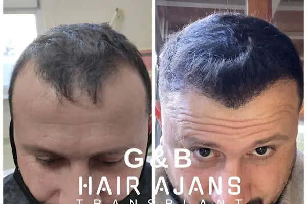 Hair Ajans Saç Ekim Merkezi - Resim 14