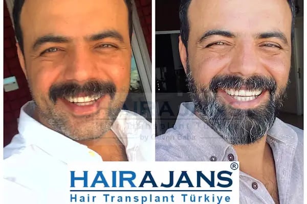 Hair Ajans Saç Ekim Merkezi - Resim 13