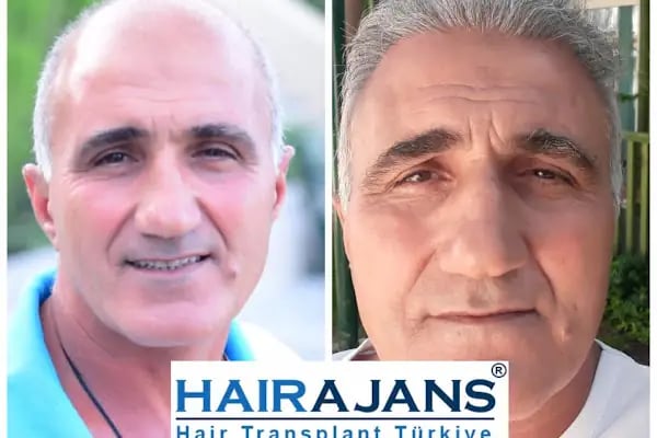 Hair Ajans Saç Ekim Merkezi - Resim 7