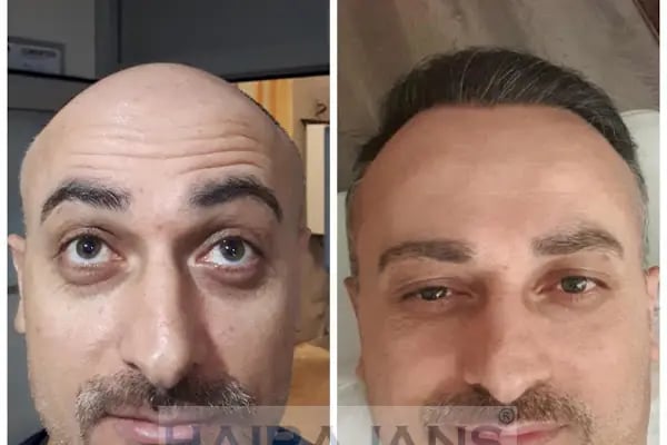 Hair Ajans Saç Ekim Merkezi - Resim 6
