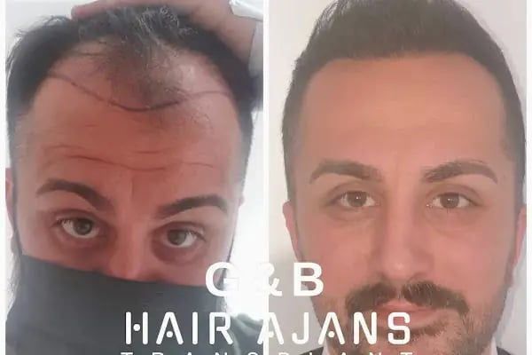 Hair Ajans Saç Ekim Merkezi - Resim 17
