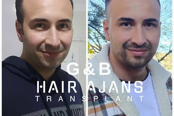 Hair Ajans Saç Ekim Merkezi - Resim 9