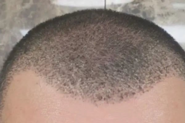 Data Hair Clinic &amp; Eyyüp Tütüncü Saç Ekim Merkezi - Resim 2