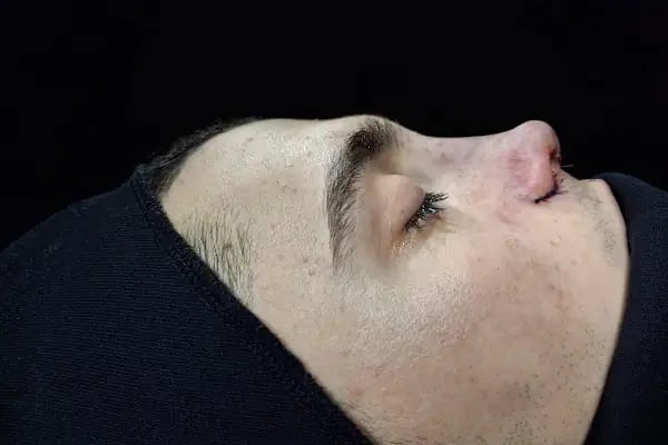 Dr. Fatih Şahin - Hair Transplant & Medical Aestethic Doctor İn Turkey - Resim 17