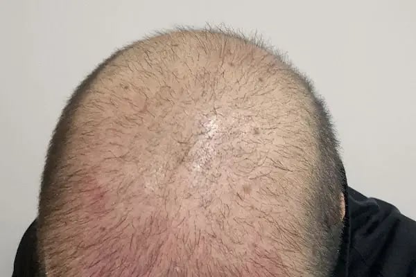 Dr. Fatih Şahin - Hair Transplant & Medical Aestethic Doctor İn Turkey - Resim 16