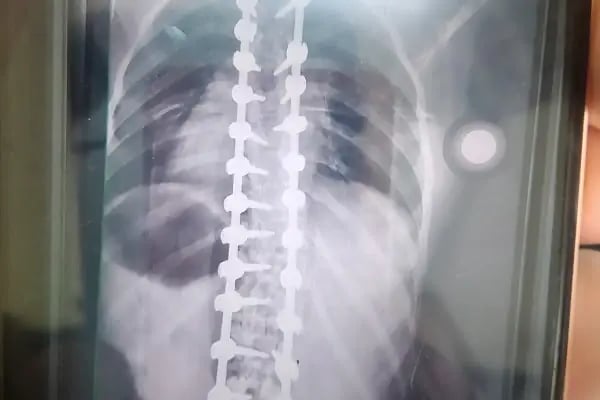 Doç. Dr. Tolga Ege, Ortopedi Ve Travmatoloji, Skolyoz, Kifoz,Omurga Eğriliği cerrahisi - Resim 7