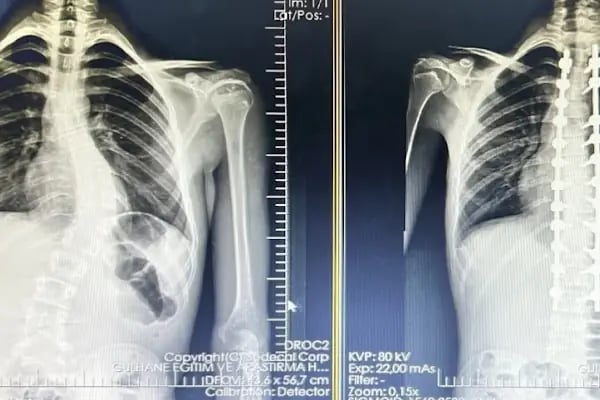 Doç. Dr. Tolga Ege, Ortopedi Ve Travmatoloji, Skolyoz, Kifoz,Omurga Eğriliği cerrahisi - Resim 15