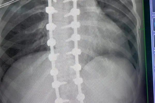 Doç. Dr. Tolga Ege, Ortopedi Ve Travmatoloji, Skolyoz, Kifoz,Omurga Eğriliği cerrahisi - Resim 4