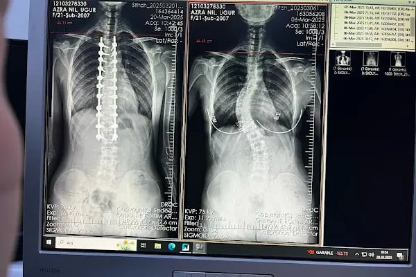 Doç. Dr. Tolga Ege, Ortopedi Ve Travmatoloji, Skolyoz, Kifoz,Omurga Eğriliği cerrahisi - Resim 3