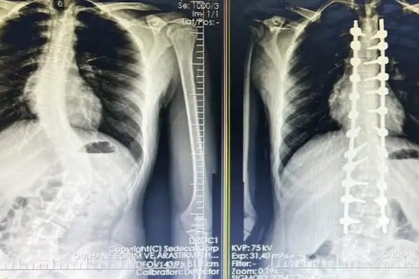 Doç. Dr. Tolga Ege, Ortopedi Ve Travmatoloji, Skolyoz, Kifoz,Omurga Eğriliği cerrahisi - Resim 19