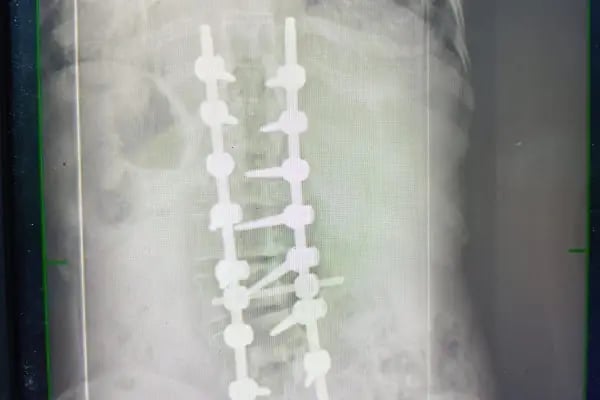 Doç. Dr. Tolga Ege, Ortopedi Ve Travmatoloji, Skolyoz, Kifoz,Omurga Eğriliği cerrahisi - Resim 5