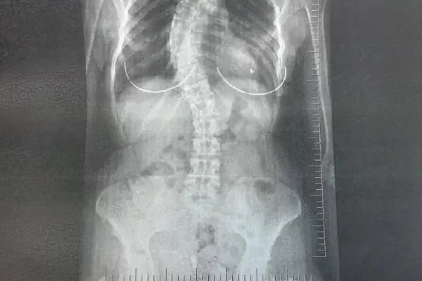Doç. Dr. Tolga Ege, Ortopedi Ve Travmatoloji, Skolyoz, Kifoz,Omurga Eğriliği cerrahisi - Resim 8