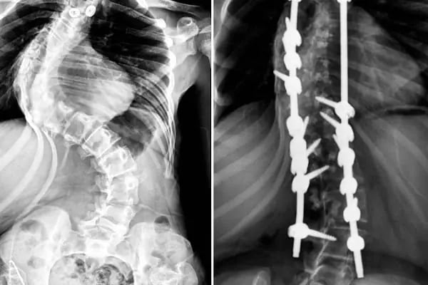 Doç. Dr. Tolga Ege, Ortopedi Ve Travmatoloji, Skolyoz, Kifoz,Omurga Eğriliği cerrahisi - Resim 13