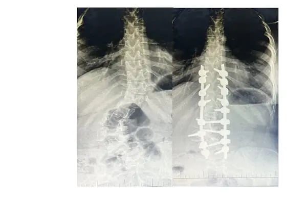 Doç. Dr. Tolga Ege, Ortopedi Ve Travmatoloji, Skolyoz, Kifoz,Omurga Eğriliği cerrahisi - Resim 16