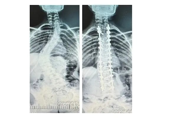 Doç. Dr. Tolga Ege, Ortopedi Ve Travmatoloji, Skolyoz, Kifoz,Omurga Eğriliği cerrahisi - Resim 17