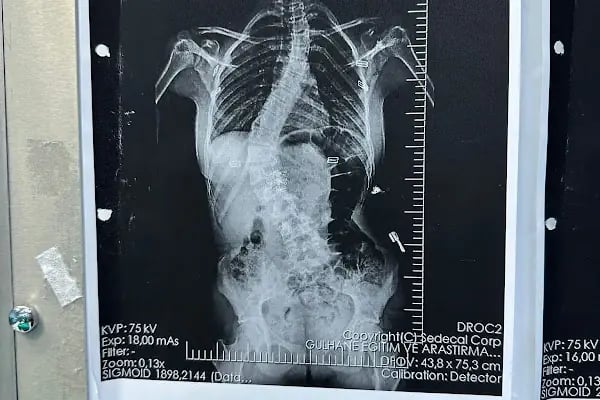 Doç. Dr. Tolga Ege, Ortopedi Ve Travmatoloji, Skolyoz, Kifoz,Omurga Eğriliği cerrahisi - Resim 2
