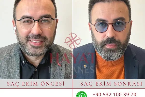 Hayat Hastanesi Saç Ekim Merkezi - Resim 15