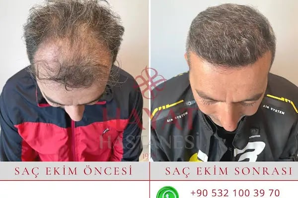 Hayat Hastanesi Saç Ekim Merkezi - Resim 11