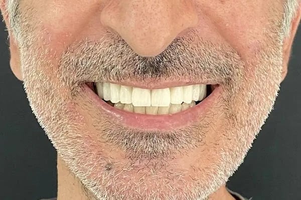 Alihan Akçam Ağız ve Diş Sağlığı Kliniği | Zirkonyum Kaplama, İmplant, Gülüş Tasarımı | Narlıdere Diş Hekimi - Resim 7