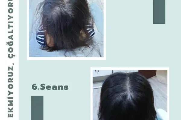 S Clinic Adana - Saç Çoğaltma, Saç Bakım ve Güzellik Merkezi - Resim 18