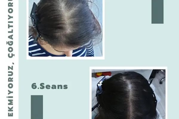 S Clinic Adana - Saç Çoğaltma, Saç Bakım ve Güzellik Merkezi - Resim 13