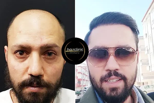 Saç Ekim Merkezi - Resim 12