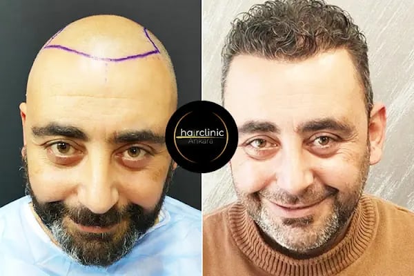 Saç Ekim Merkezi - Resim 10