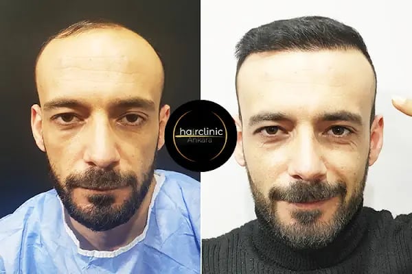 Saç Ekim Merkezi - Resim 6