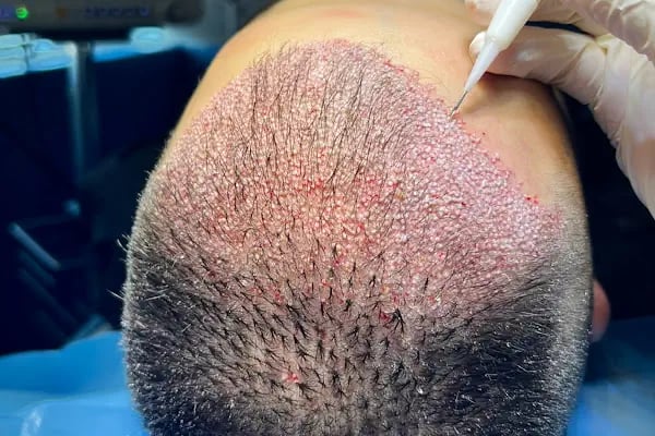 DHI Clinic Turkey - VIP DHI Hair Transplantation - Resim 18