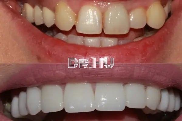 Dr.Hu Ağız Ve Diş Sağlığı Polikliniği | Konya Diş Hekimi, İmplant, Zirkonyum, Gülüş Tasarımı - Resim 20