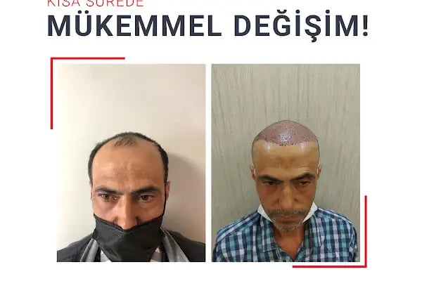 Fue Saç Ekimi Burak Karakaş - Resim 10