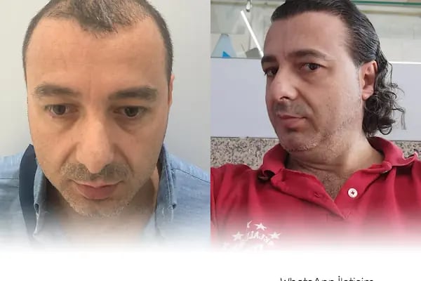 Fue Saç Ekimi Burak Karakaş - Resim 15