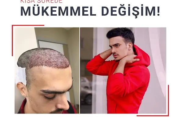 Fue Saç Ekimi Burak Karakaş - Resim 4